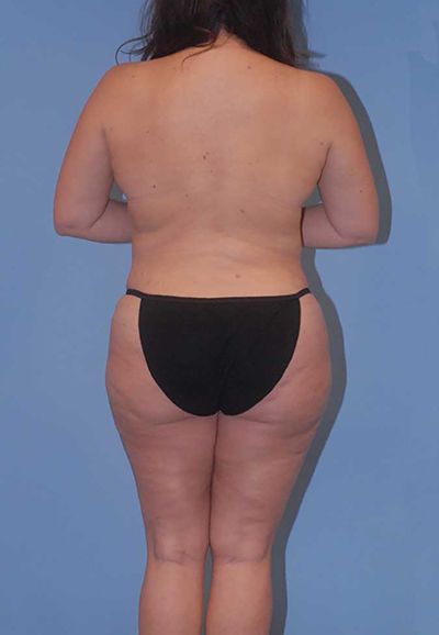 Abdominoplasty Before & After