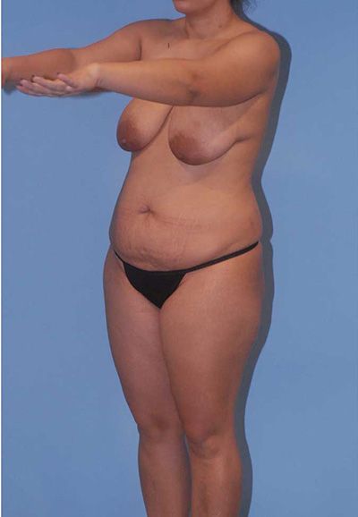 Abdominoplasty Before & After