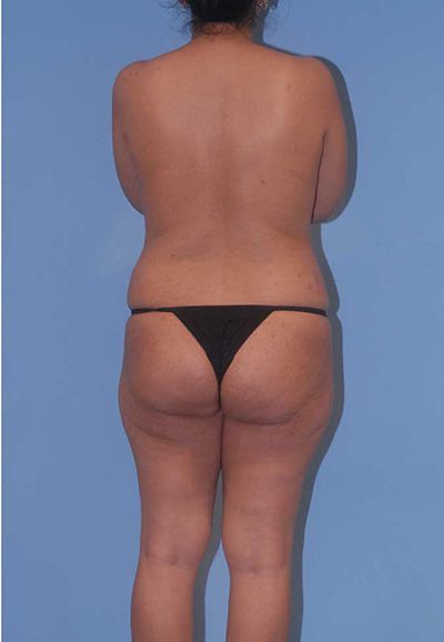 Abdominoplasty Before & After