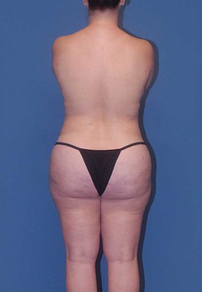 Abdominoplasty Before & After