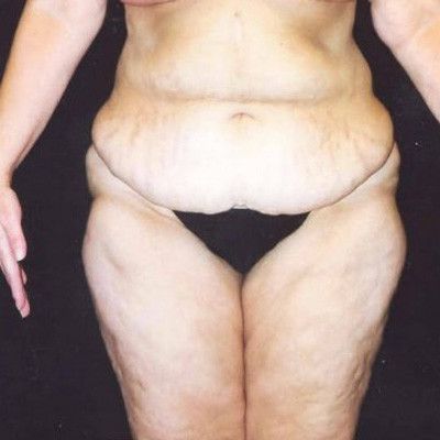 Abdominoplasty Before & After