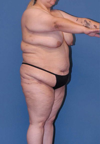 Abdominoplasty Before & After