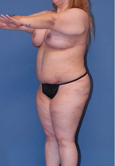 Abdominoplasty Before & After