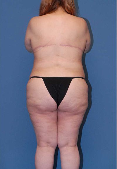 Abdominoplasty Before & After