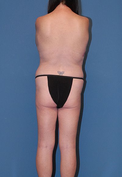 Abdominoplasty Before & After