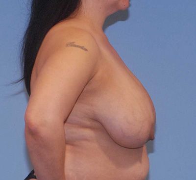 Abdominoplasty Before & After