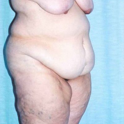 Abdominoplasty Before & After