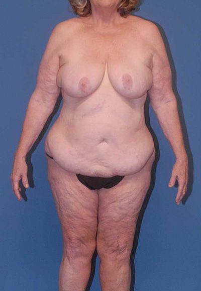 Abdominoplasty Before & After