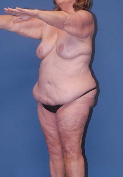 Abdominoplasty Before & After