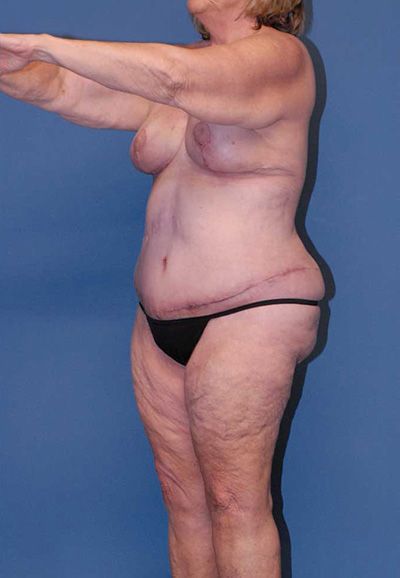 Abdominoplasty Before & After