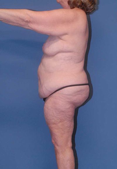 Abdominoplasty Before & After