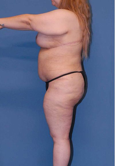 Abdominoplasty Before & After