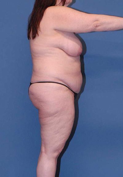 Abdominoplasty Before & After