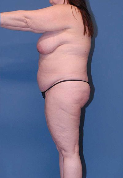 Abdominoplasty Before & After