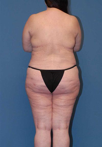 Abdominoplasty Before & After