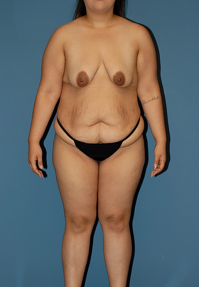 Abdominoplasty Before & After