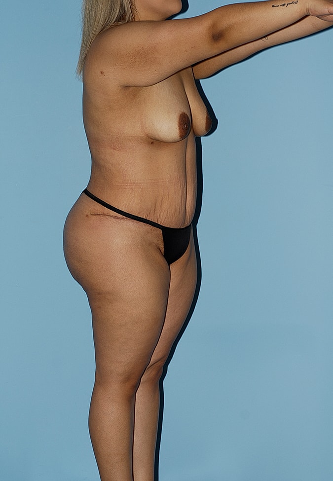 Abdominoplasty Before & After