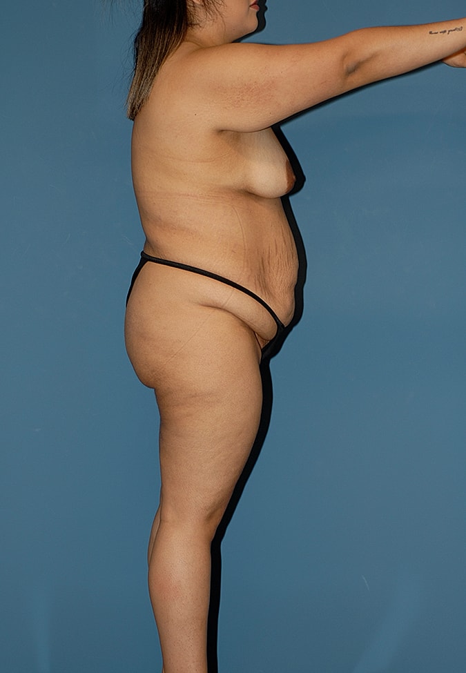 Abdominoplasty Before & After