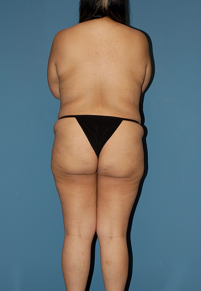 Abdominoplasty Before & After
