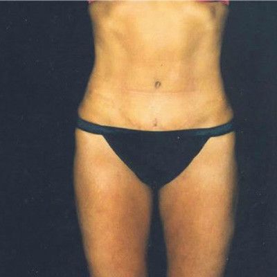 Abdominoplasty Before & After