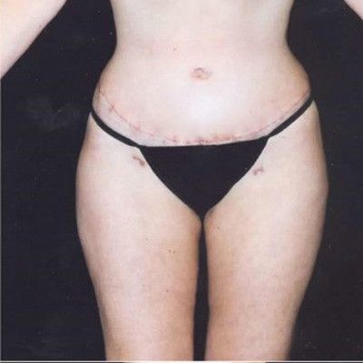 Abdominoplasty Before & After