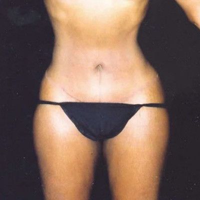 Abdominoplasty Before & After