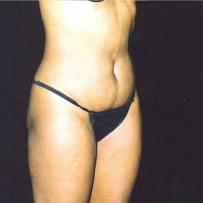 Abdominoplasty Before & After