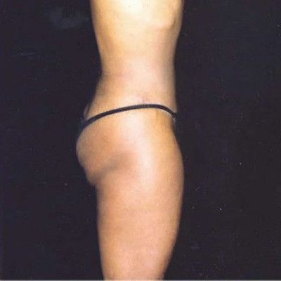 Abdominoplasty Before & After