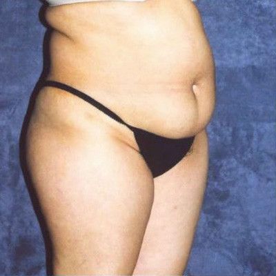 Abdominoplasty Before & After