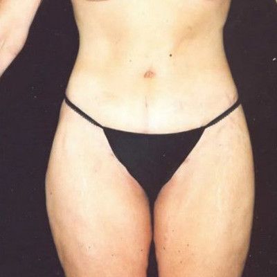 Abdominoplasty Before & After