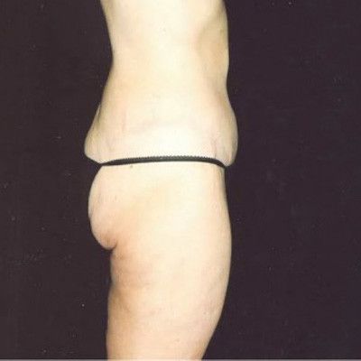 Abdominoplasty Before & After