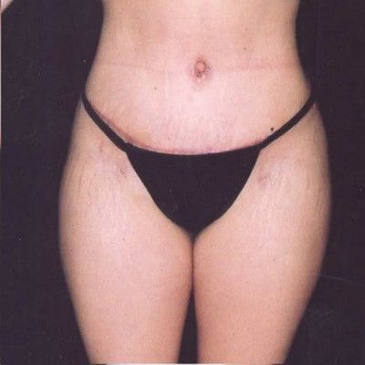 Abdominoplasty Before & After