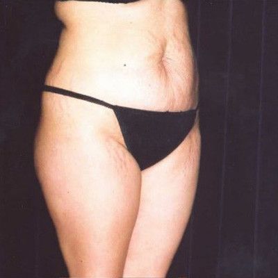 Abdominoplasty Before & After