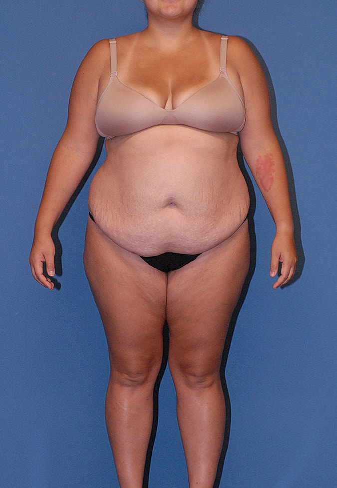 Abdominoplasty Before & After