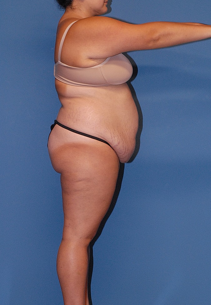 Abdominoplasty Before & After