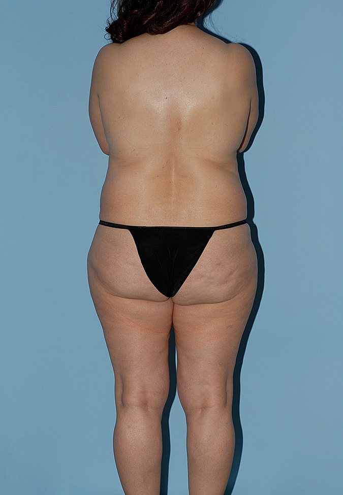 Abdominoplasty Before & After
