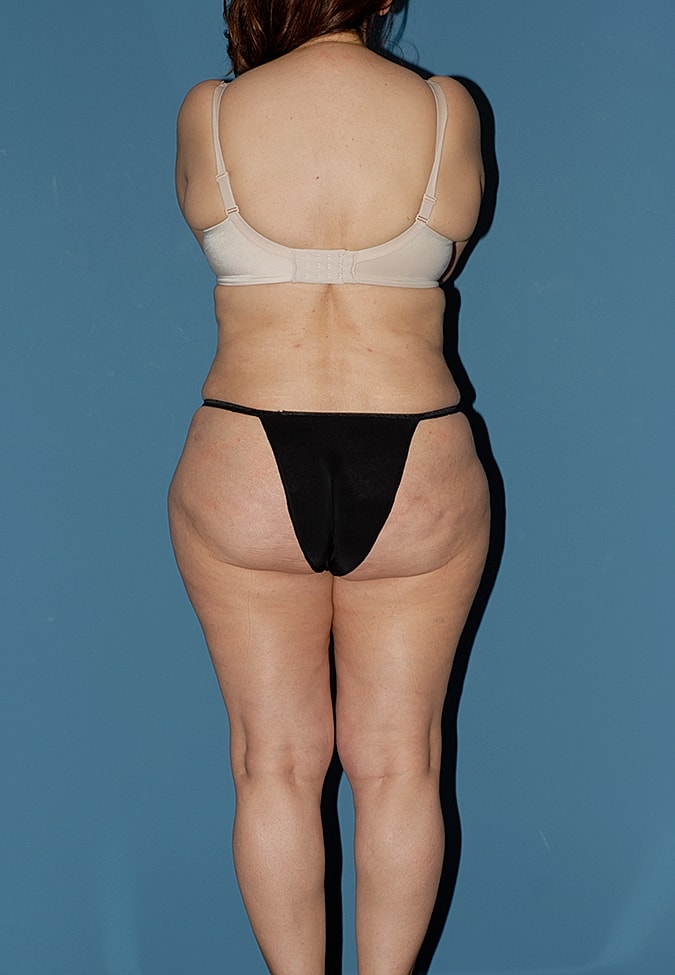 Abdominoplasty Before & After