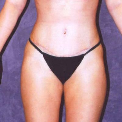 Abdominoplasty Before & After