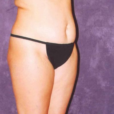 Abdominoplasty Before & After