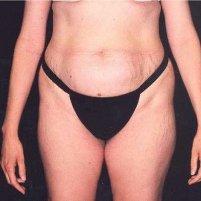Abdominoplasty Before & After