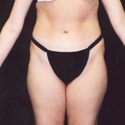 Abdominoplasty Before & After