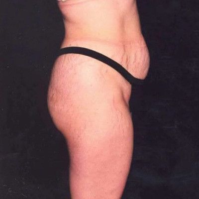 Abdominoplasty Before & After