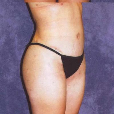 Abdominoplasty Before & After