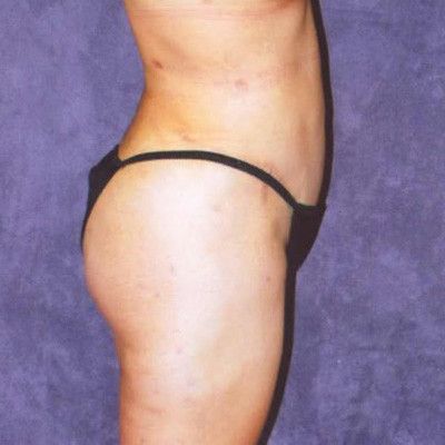 Abdominoplasty Before & After