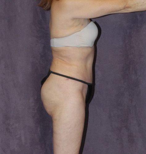 Abdominoplasty Before & After