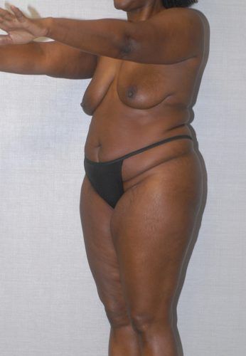 Abdominoplasty Before & After