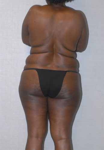 Abdominoplasty Before & After