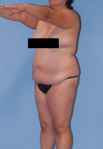 Abdominoplasty Before & After