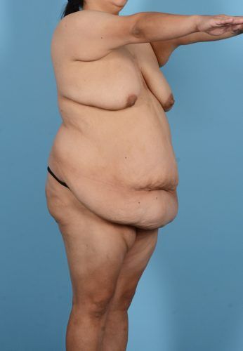 Abdominoplasty Before & After