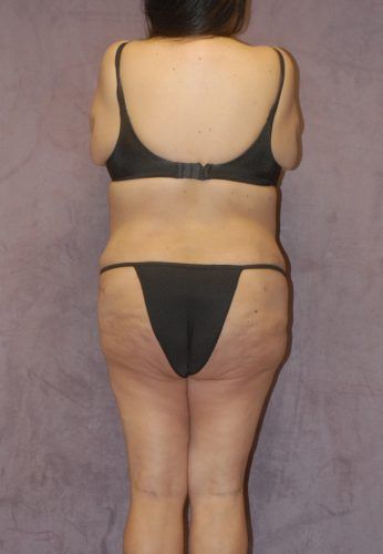 Abdominoplasty Before & After